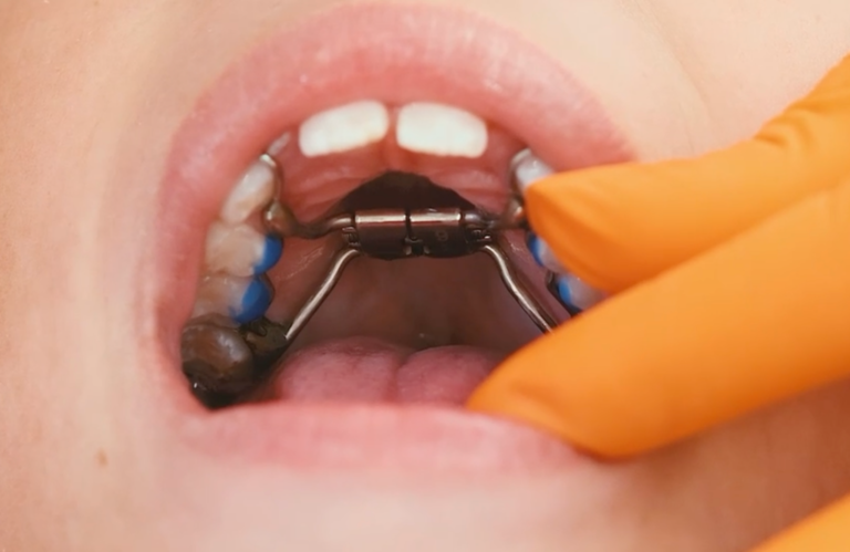 Consulta de instalação do expansor na criança
